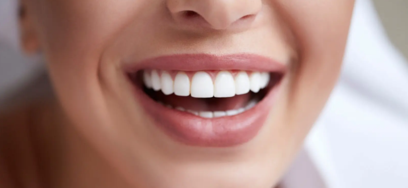 Everything you need to know about Veneers