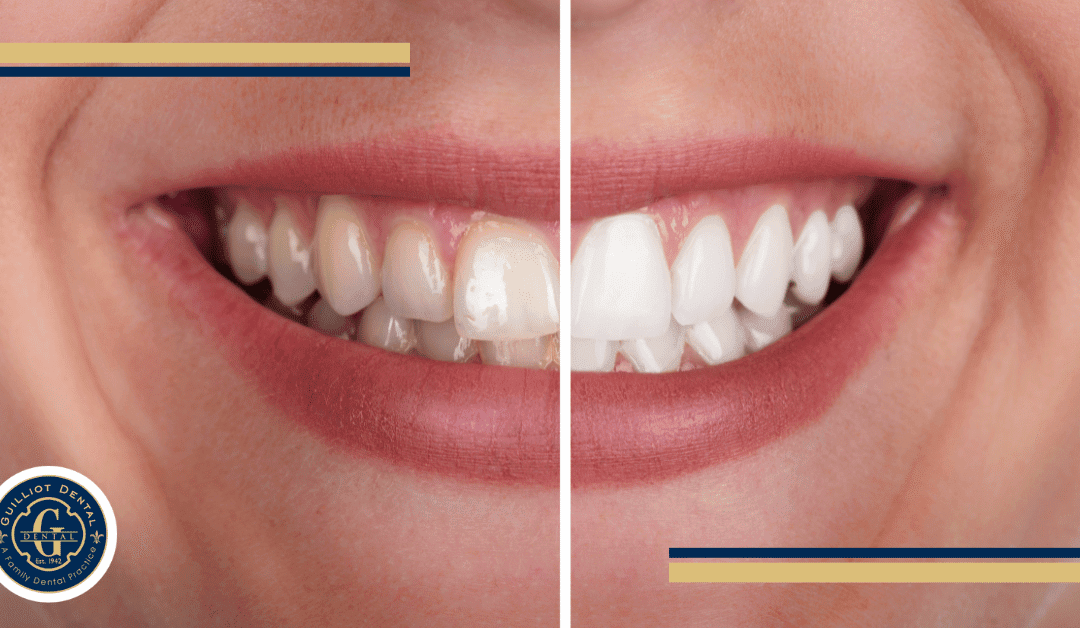 Teeth Whitening: Professional vs At Home – How Long Do They Last